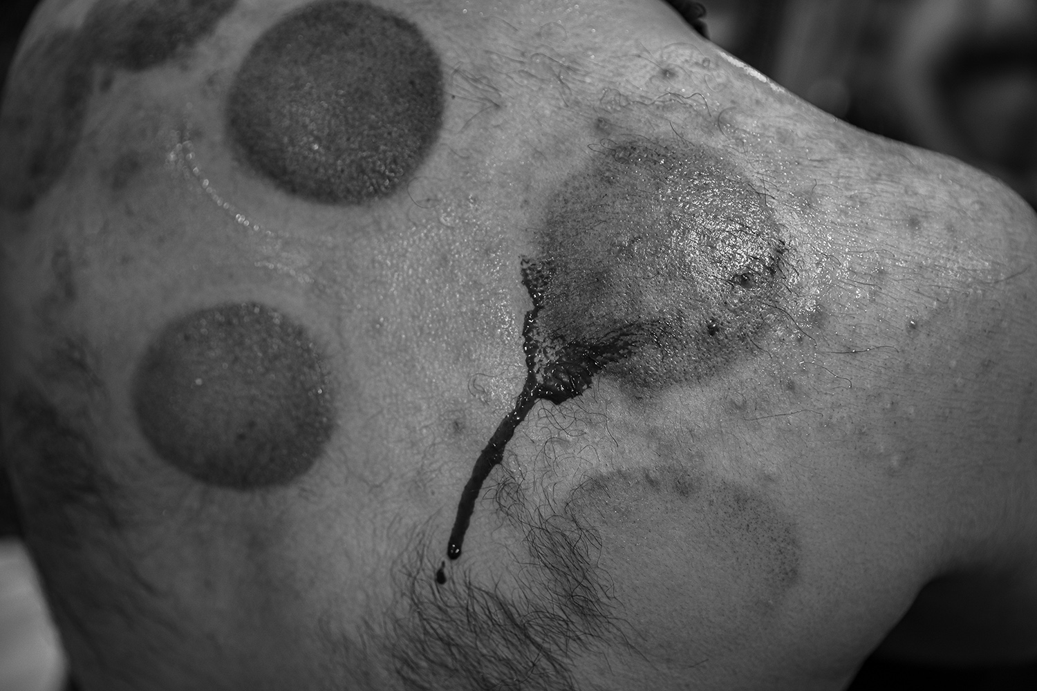 9 - Koolbars do cupped once every few months. They believe that cupping, apart from removi