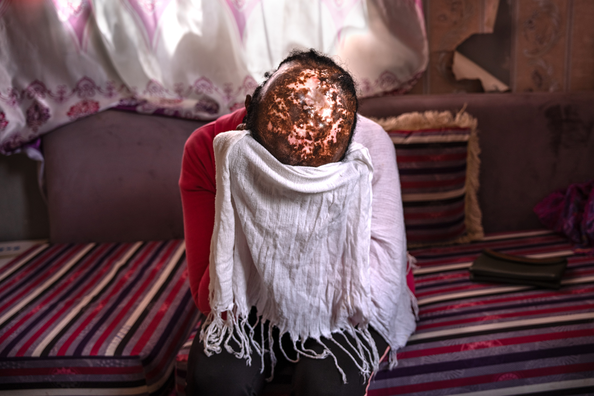 9 - Hayla reveals a scar acquired during a brutal mass acid attack amid the conflict - 9b4.jpg