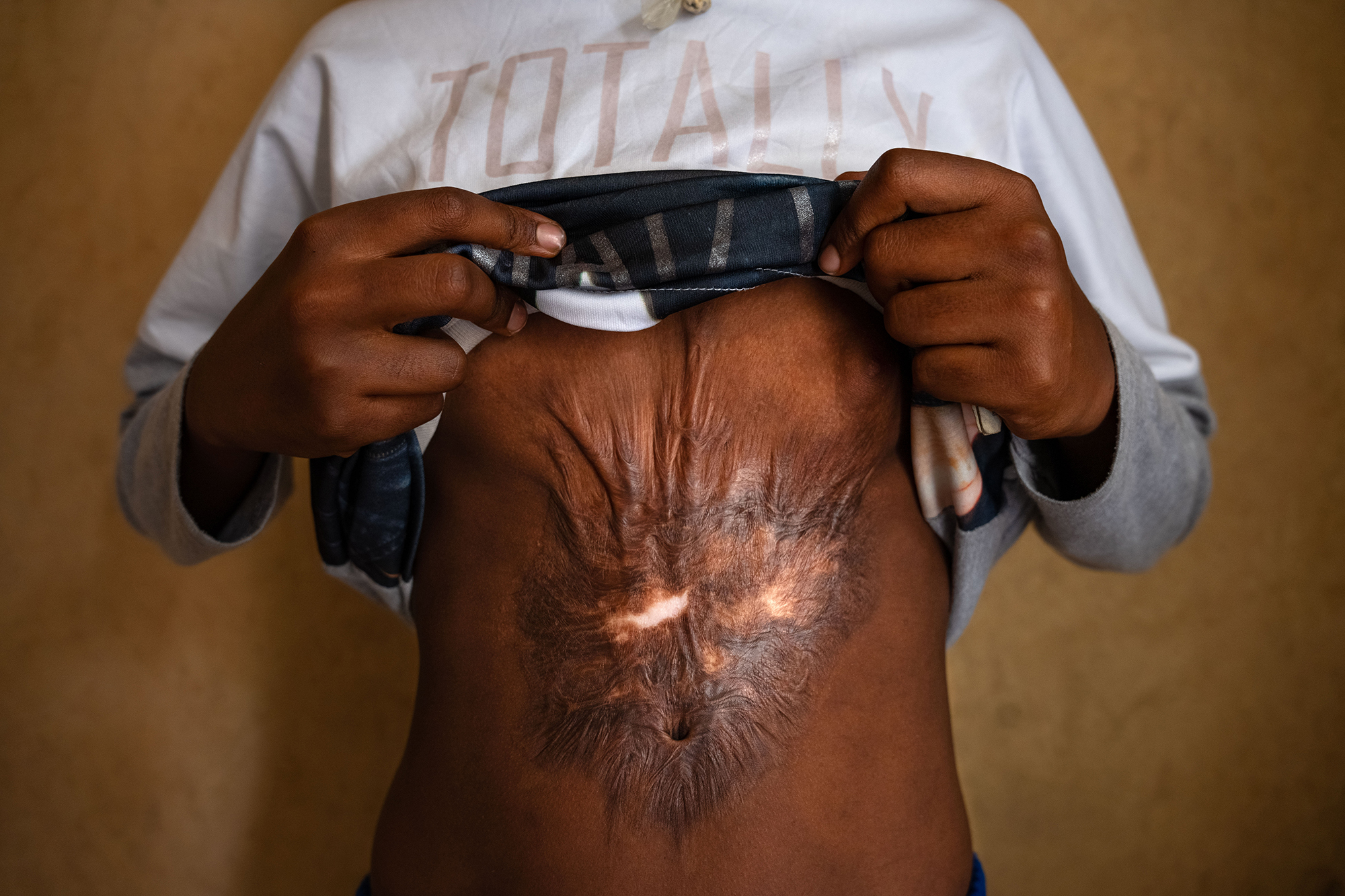 5 - Twelve-year-old Eskedar reveals a scar resulting from an attack by four soldiers durin.jpg